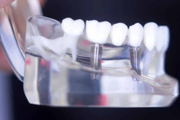 all on implants restore lost teeth