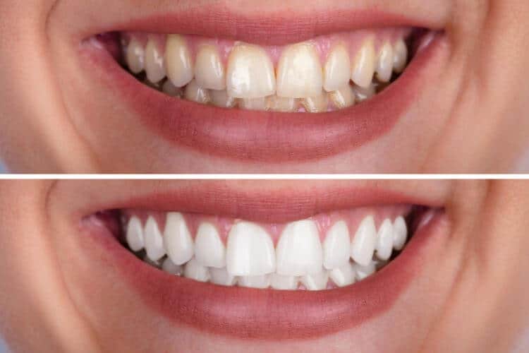 teeth whitening at home or in office