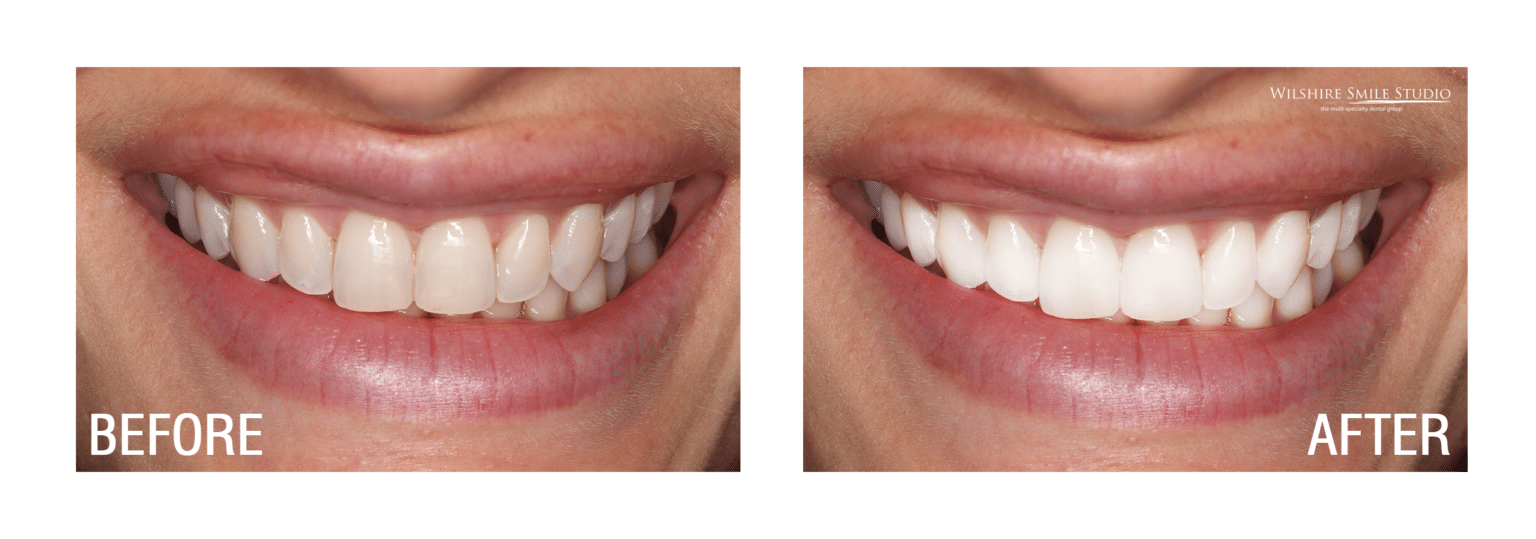 Before and After Wilshire Smile Studio