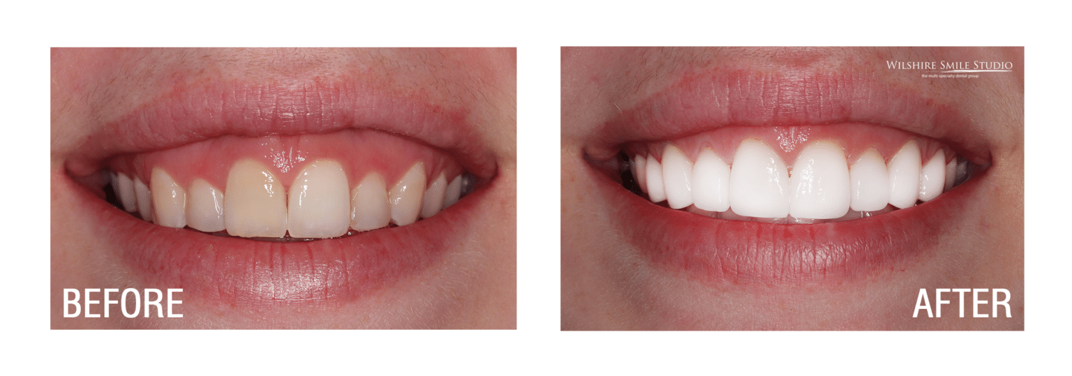 Before and After Wilshire Smile Studio