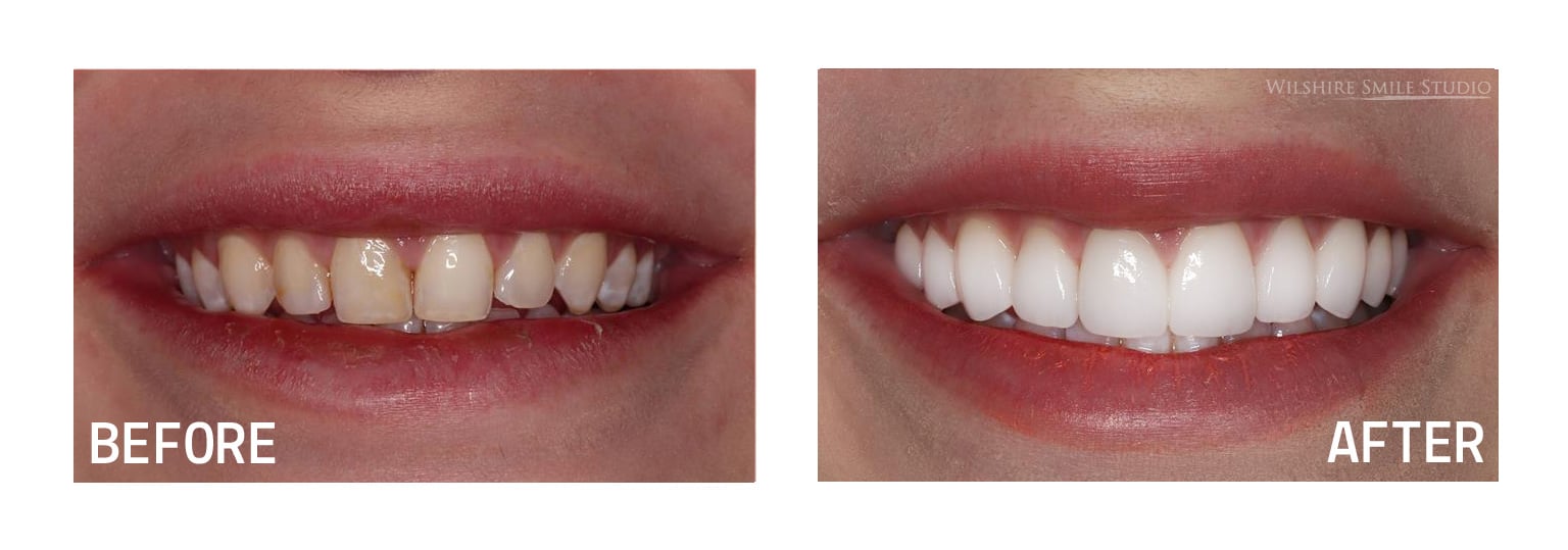 Wilshire Smile Studio Before and After