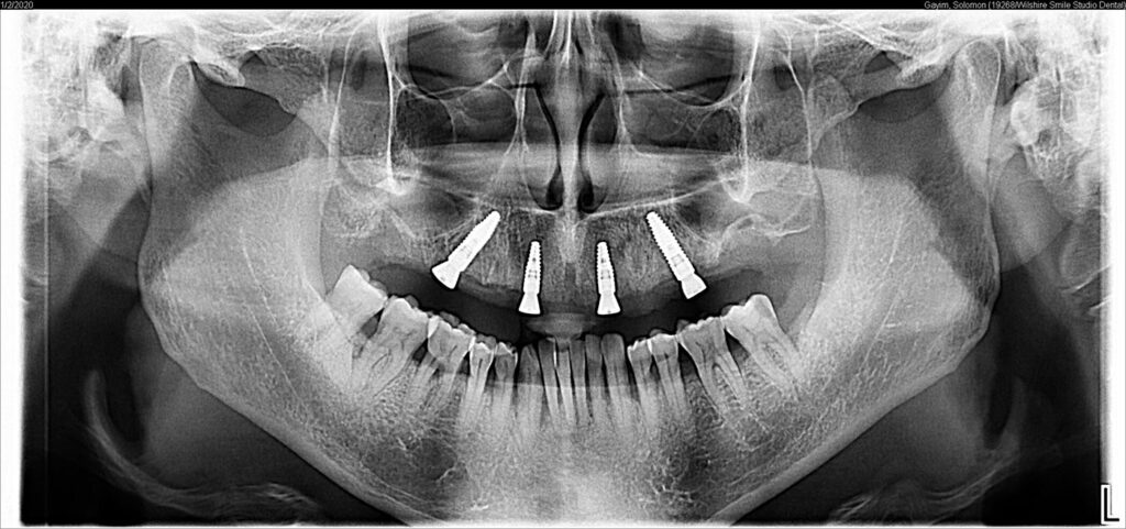 All On Dental Implants