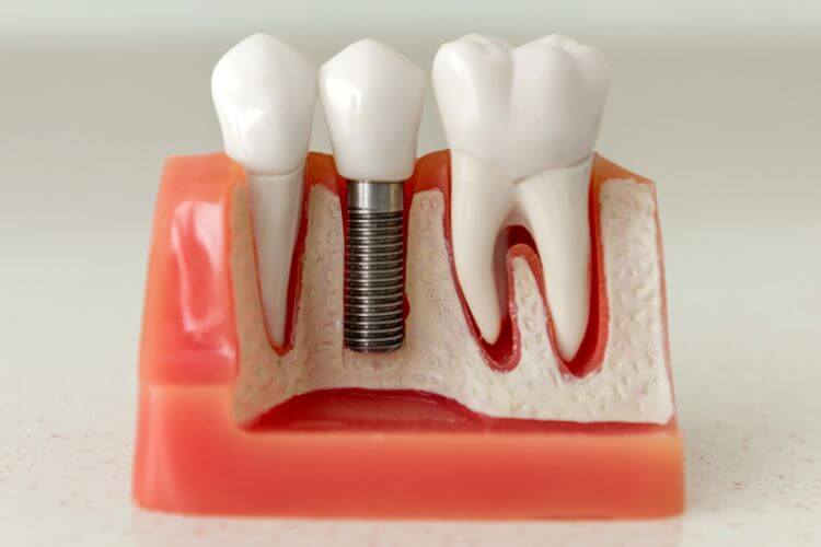 latest dental implant questions answered figure