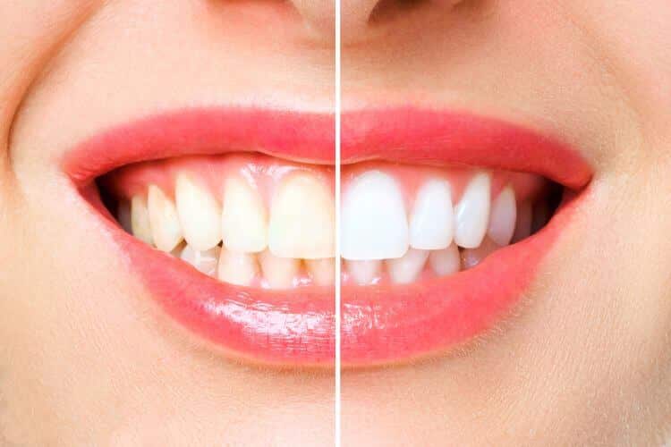 teeth whitening can change lives