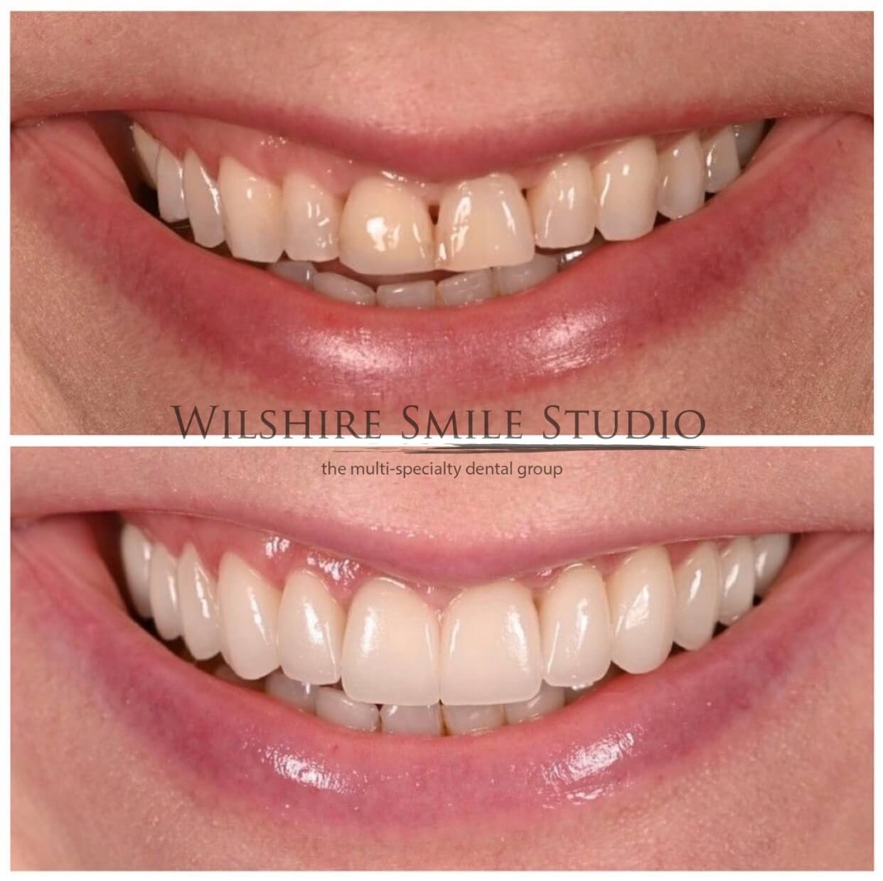 Veneers Los Angeles