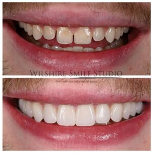 Dental Veneers Wilshire Smile Studio