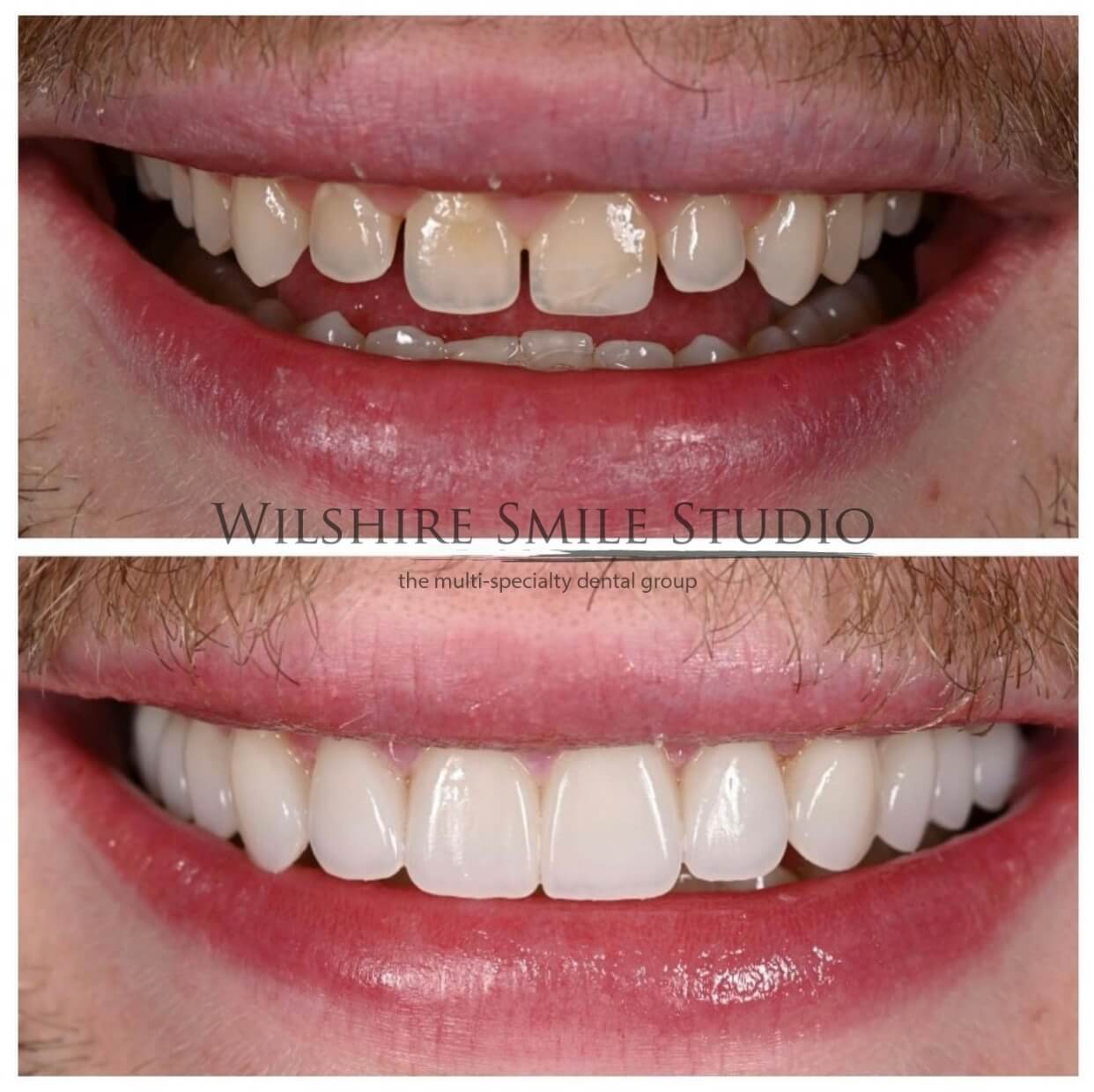 Teeth Whitening Los Angeles