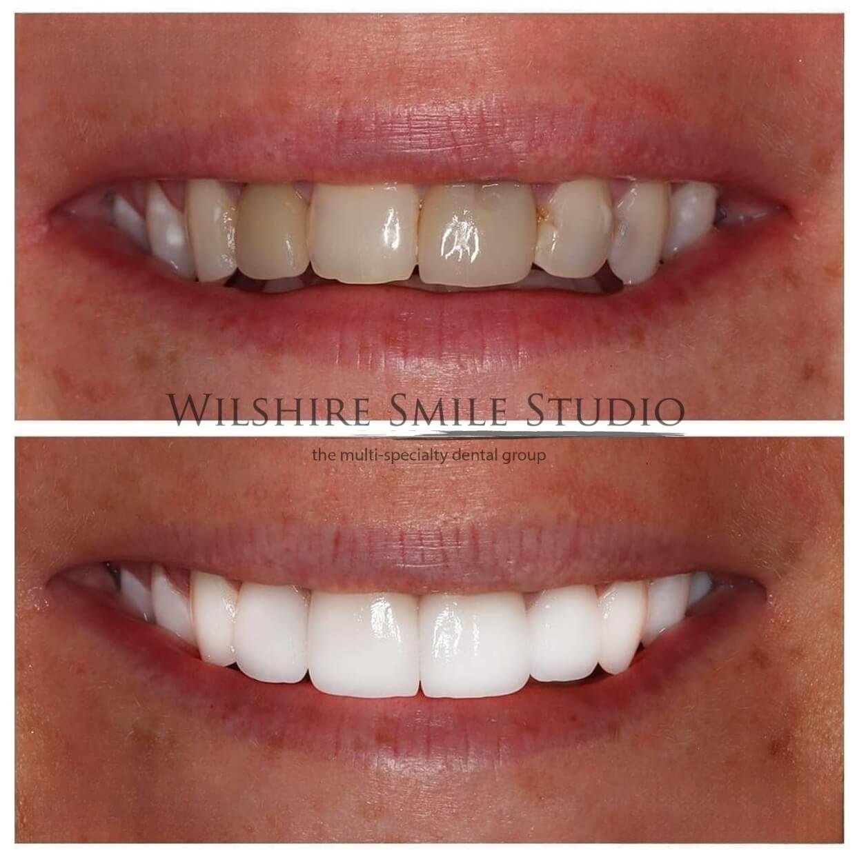 Dental_Veneers_Wilshire_Smile_Studio_13