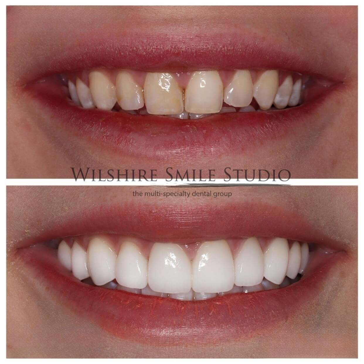 Dental_Veneers_Wilshire_Smile_Studio_14