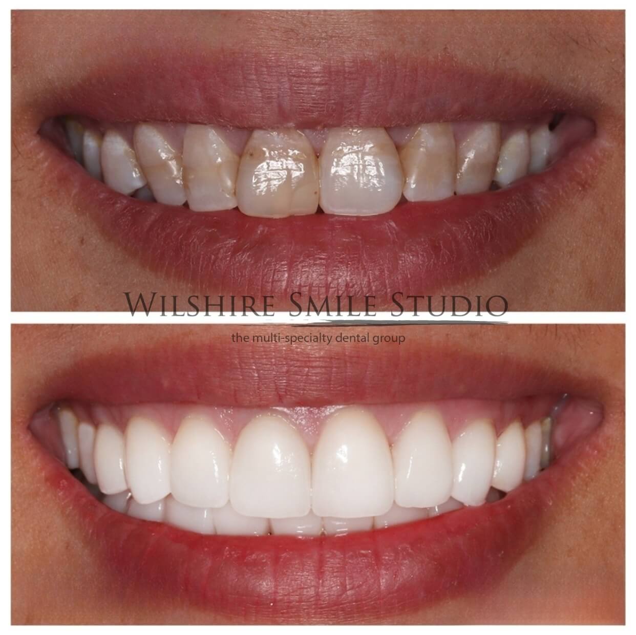 Dental_Veneers_Wilshire_Smile_Studio_15