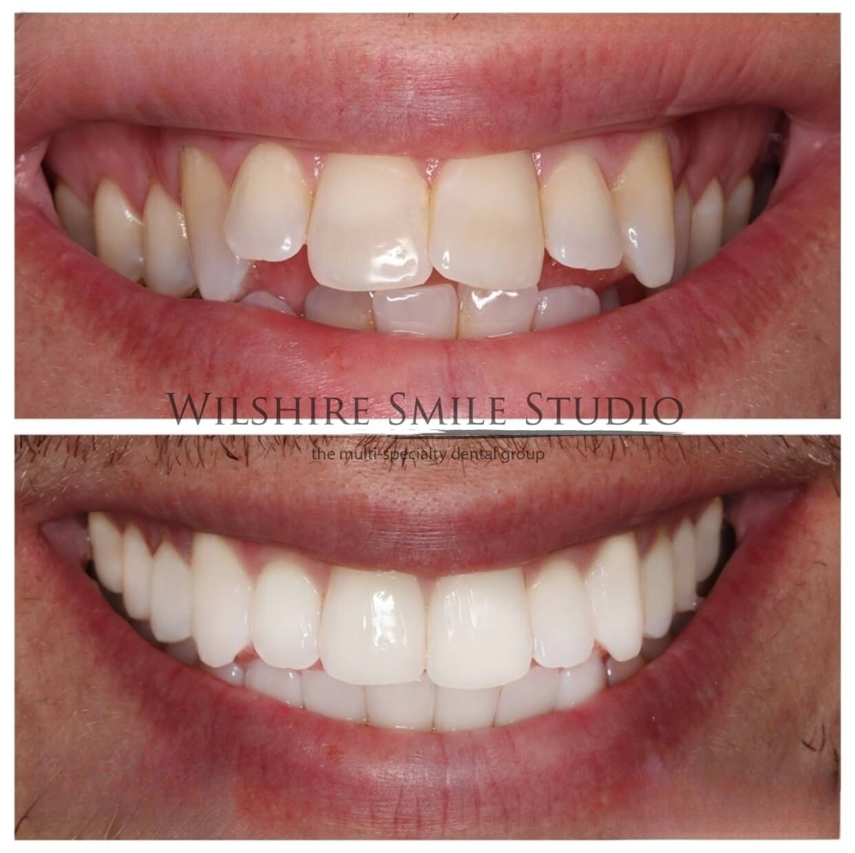 Dental_Veneers_Wilshire_Smile_Studio_16