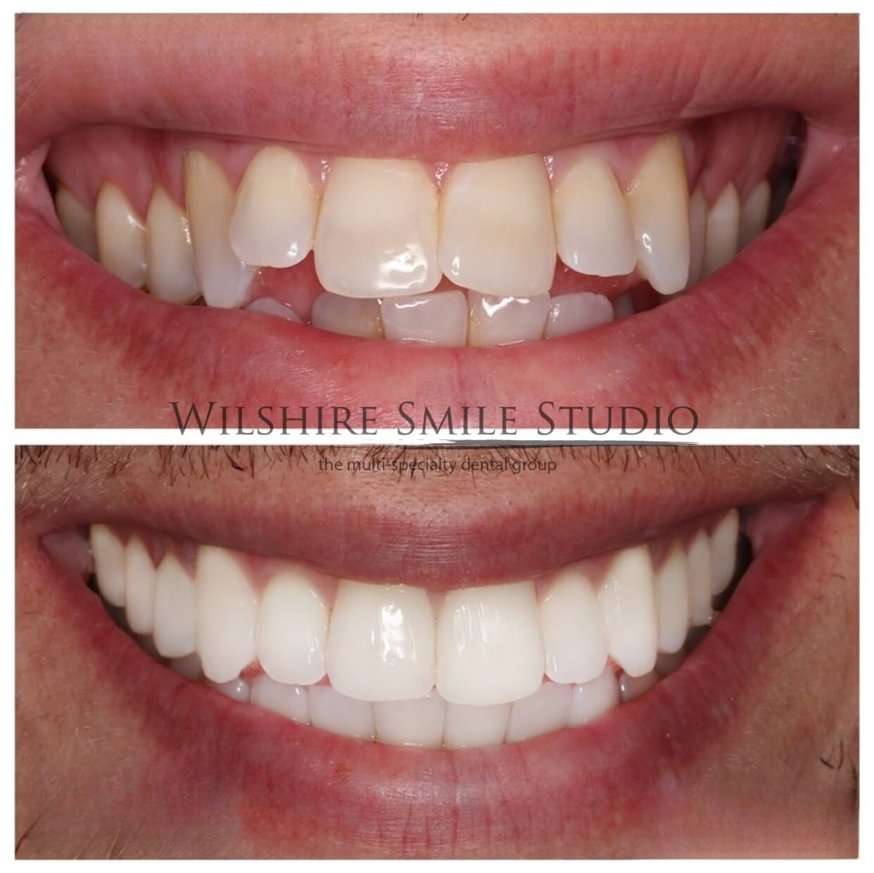 Teeth Whitening Los Angeles