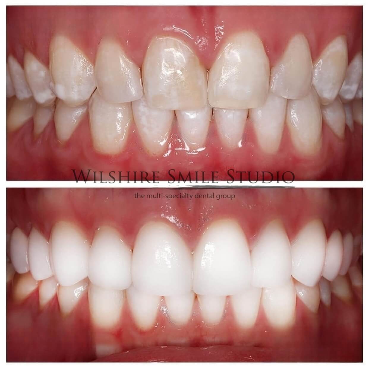 Dental_Veneers_Wilshire_Smile_Studio_19
