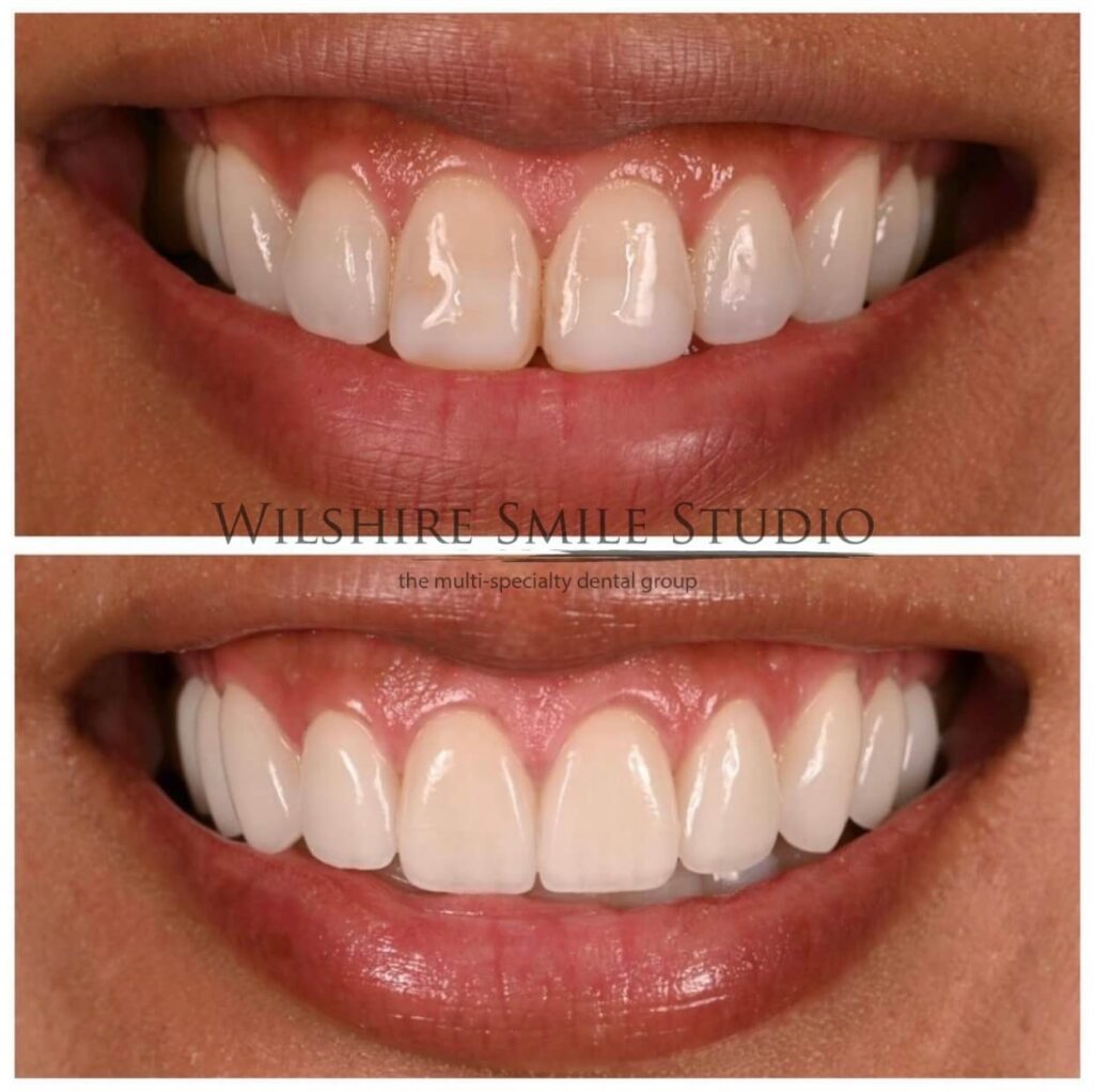Dental Veneers Wilshire Smile Studio