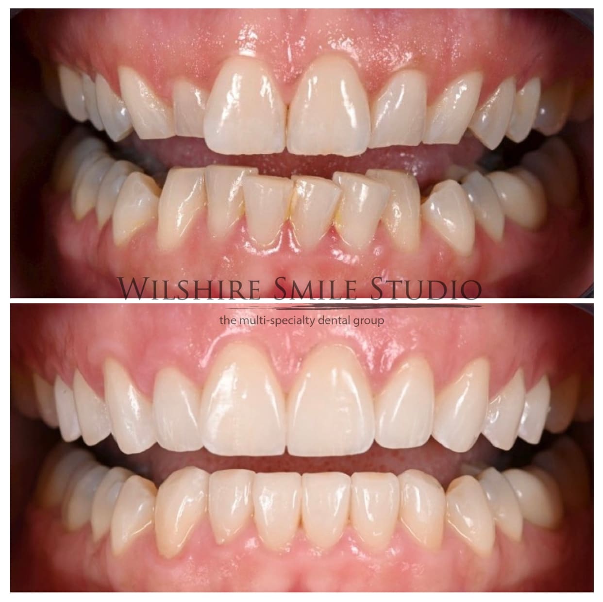 Dental_Veneers_Wilshire_Smile_Studio_24