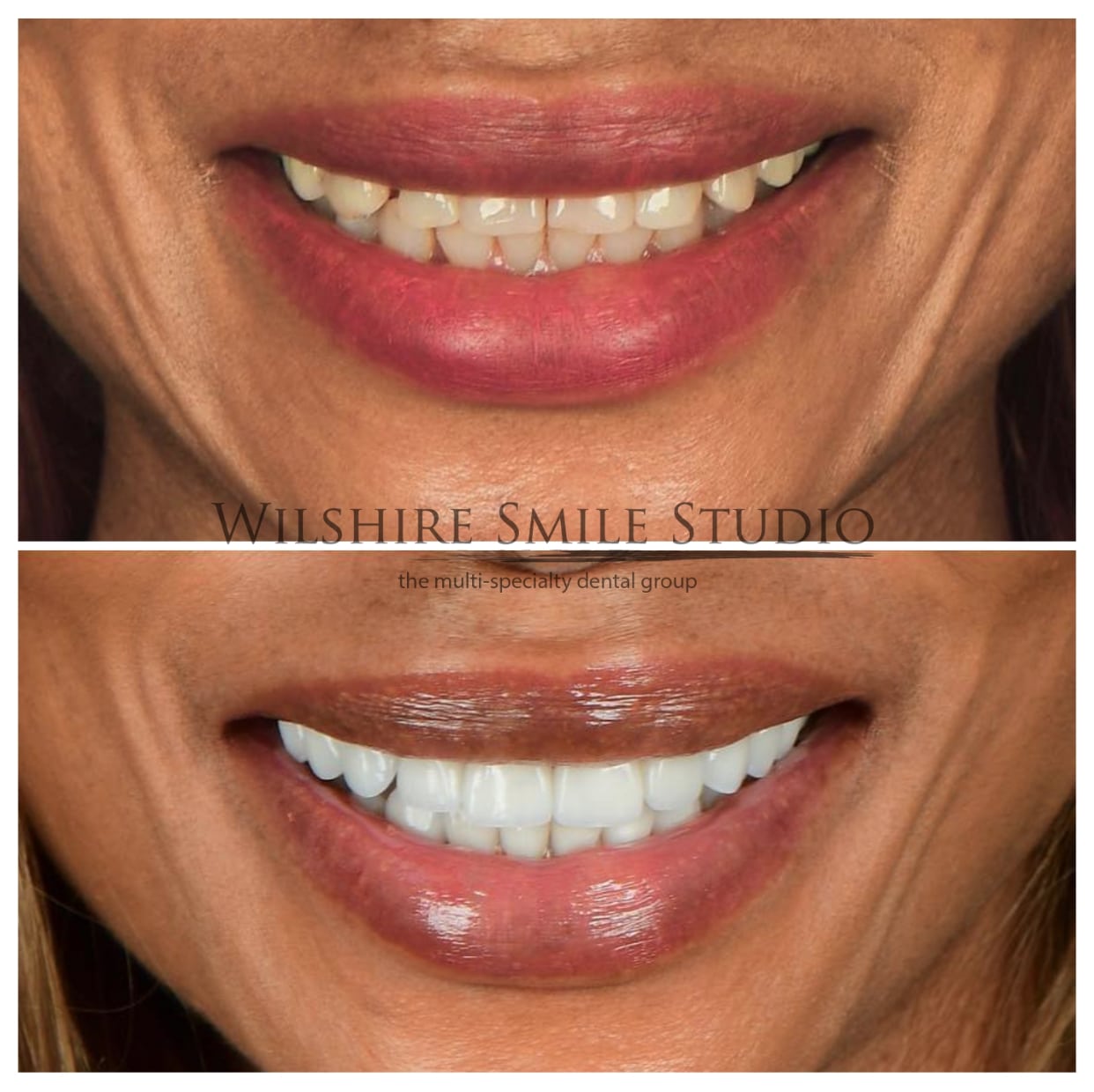 Dental_Veneers_Wilshire_Smile_Studio_25