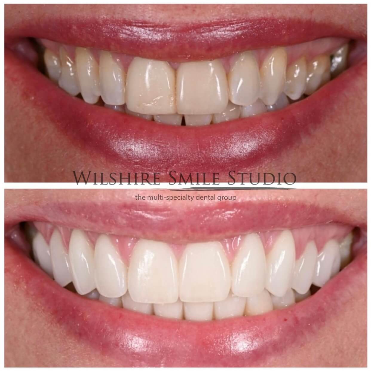 Dental_Veneers_Wilshire_Smile_Studio_4