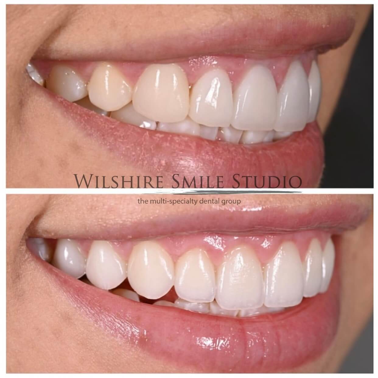 Dental_Veneers_Wilshire_Smile_Studio_7