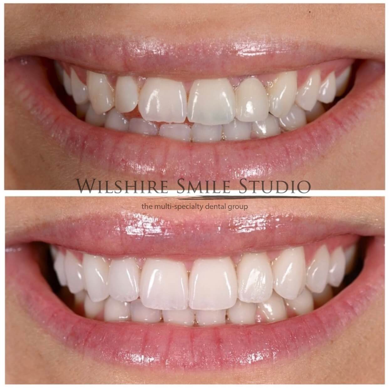 Dental_Veneers_Wilshire_Smile_Studio_9