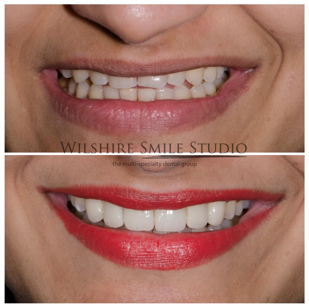 Dental_Veneers_Wilshire_Smile_Studio_twentyone