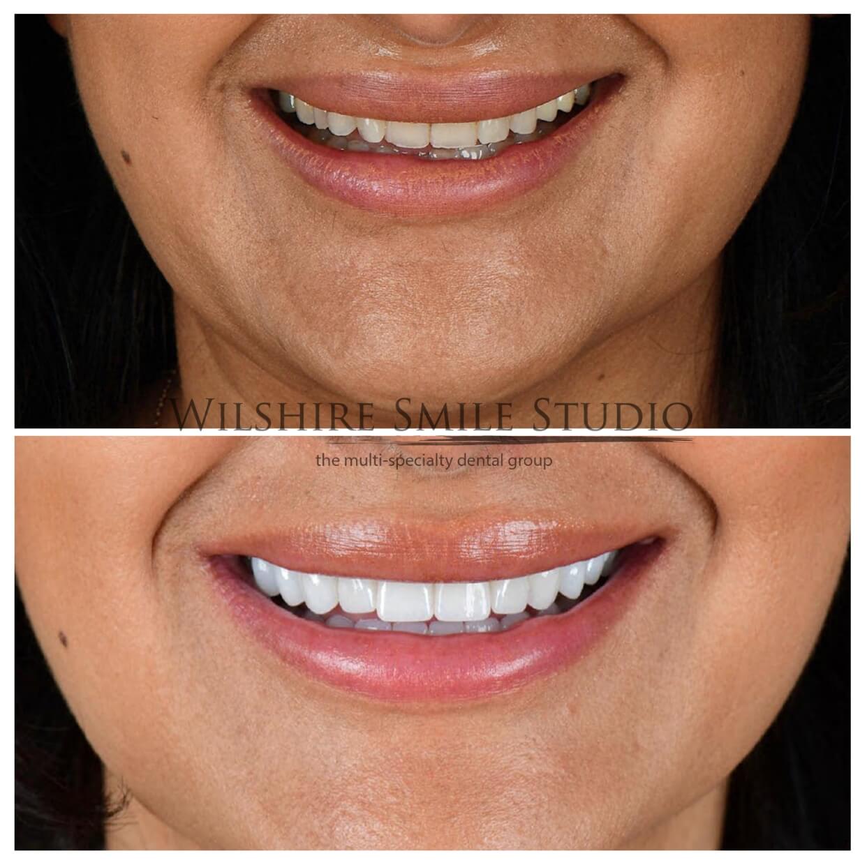 Dental Veneers Wilshire Smile Studio twentythree