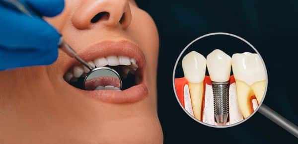 Advantages of Dental Implants Los Angeles