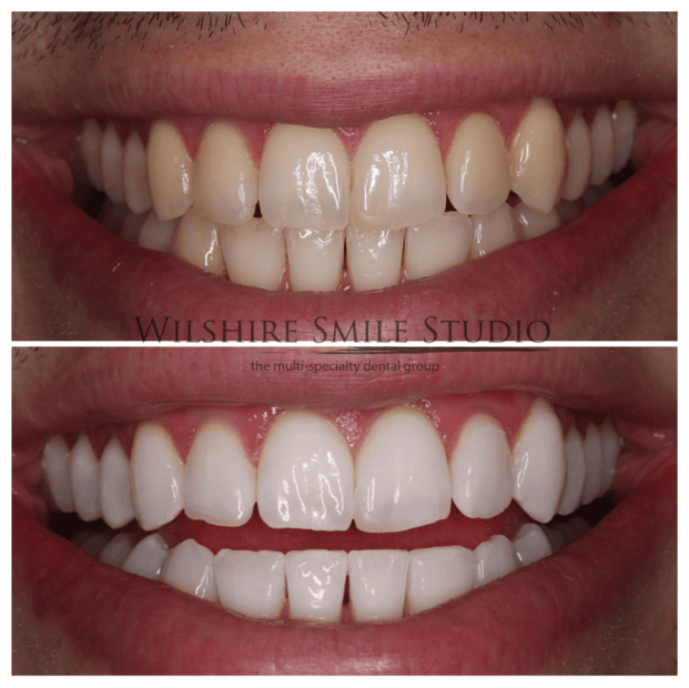 Teeth-Whitening-WSS-1