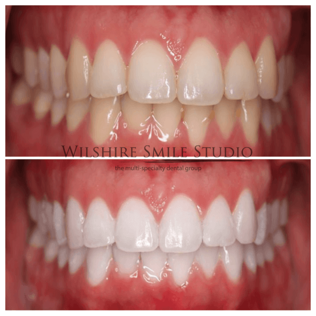 Teeth Whitening WSS
