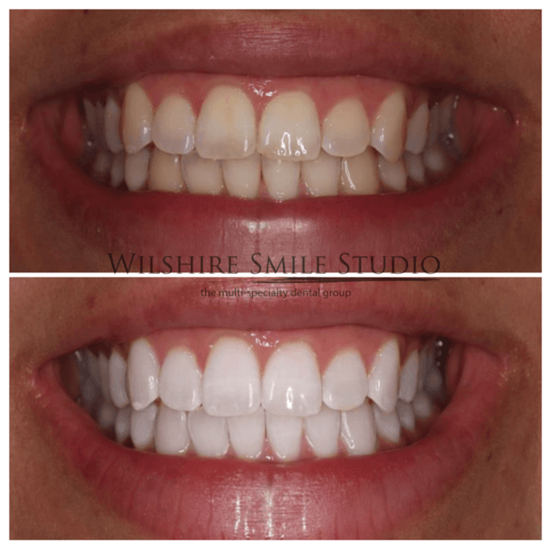Teeth-Whitening-WSS-12