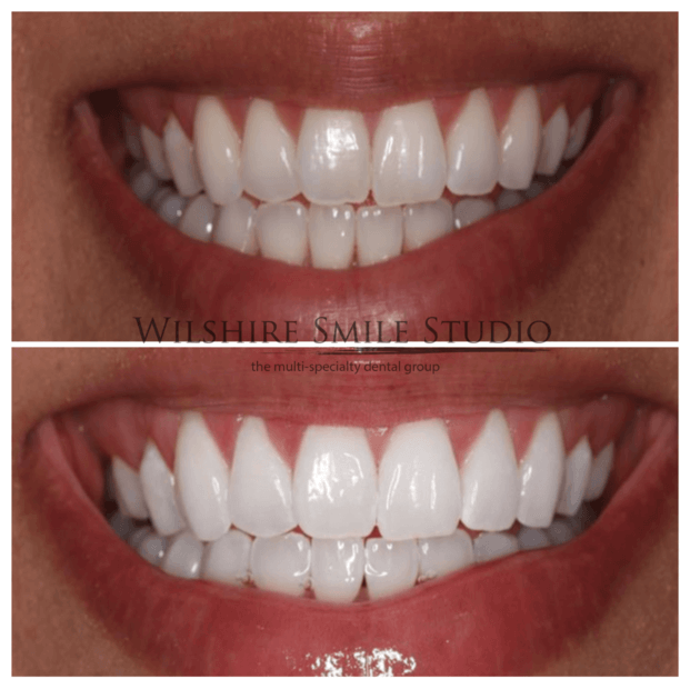 Teeth-Whitening-WSS-13
