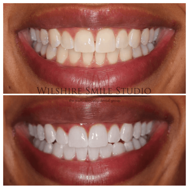 Teeth-Whitening-WSS-14