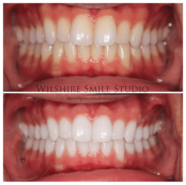 Teeth-Whitening-WSS-15