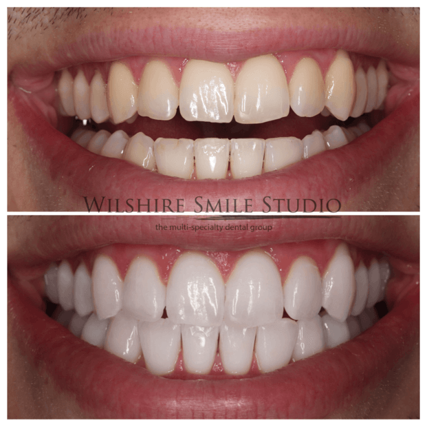 Teeth-Whitening-WSS-2