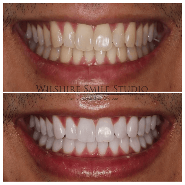 Teeth-Whitening-WSS-3