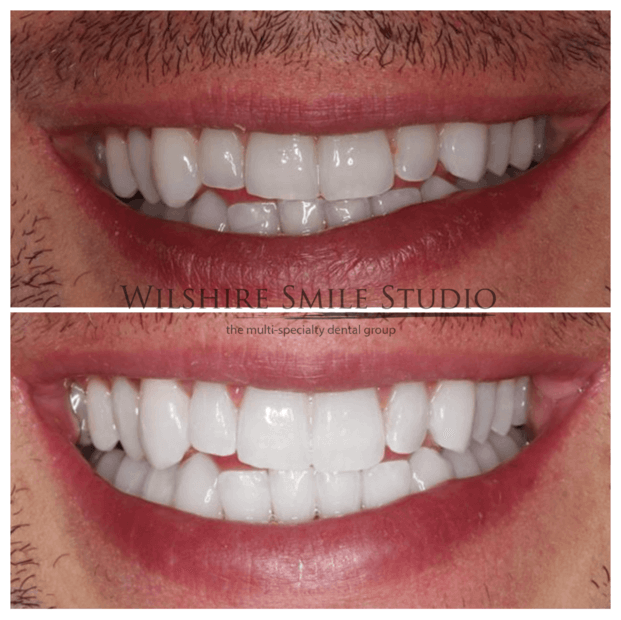 Teeth-Whitening-WSS-4