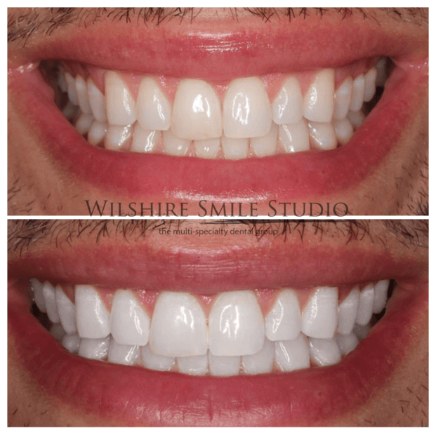 Teeth-Whitening-WSS-5