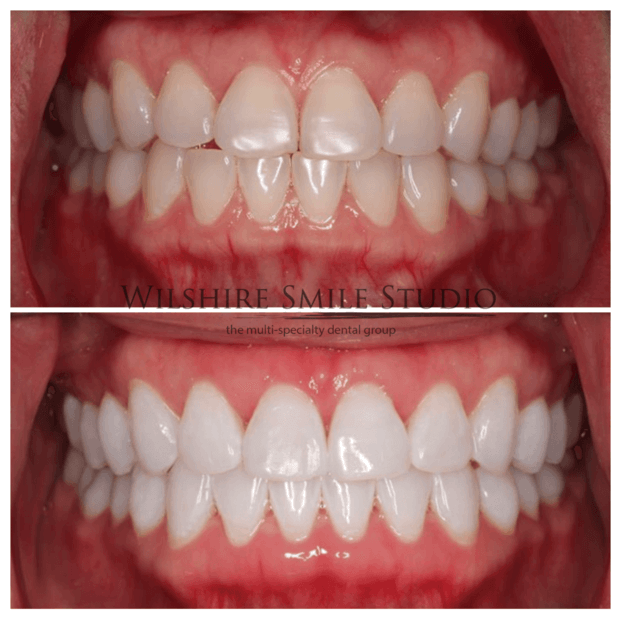 Teeth Whitening WSS