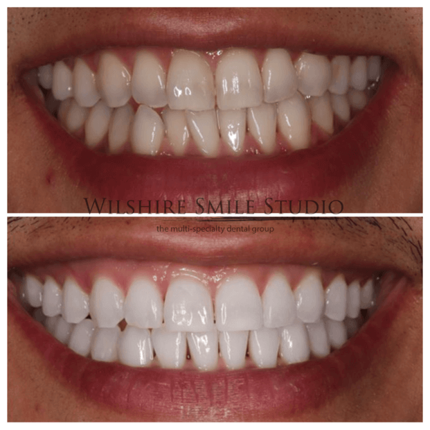 Teeth-Whitening-WSS-7
