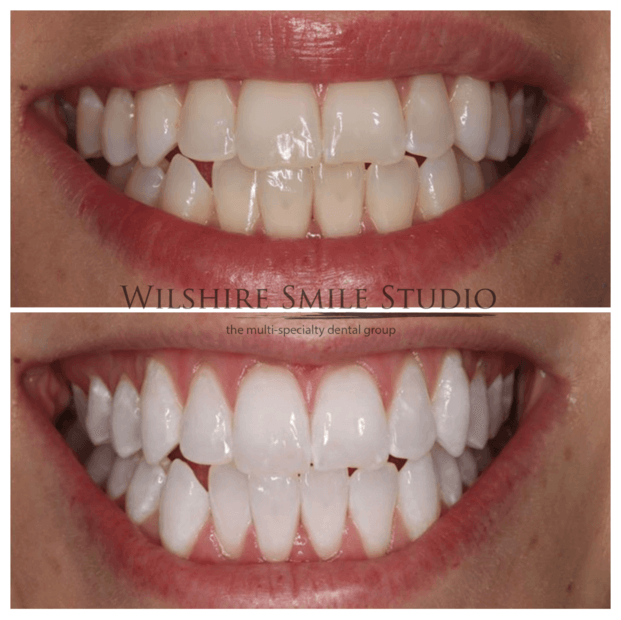 Teeth-Whitening-WSS-8