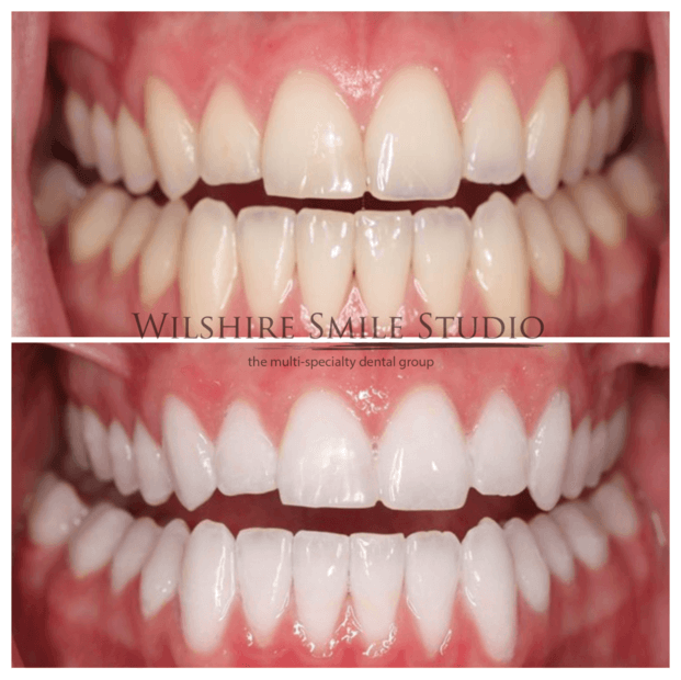 Teeth-Whitening-WSS-9