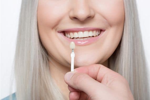 Things To Know Dental Veneers Wilshire Smile Studio