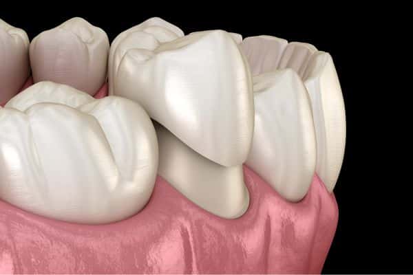 Dental crown being put on a set of teeth