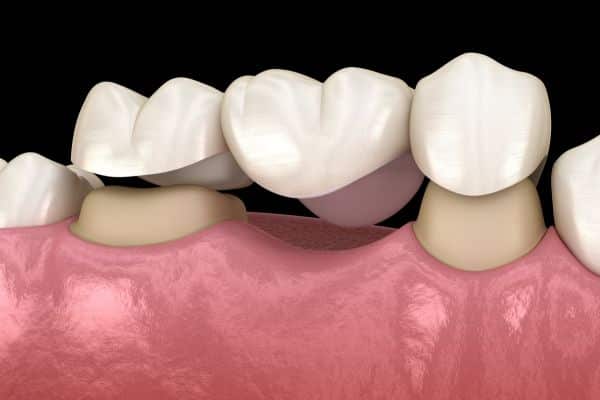 You Have a Reason to Smile When Dental Crowns Come to the Rescue