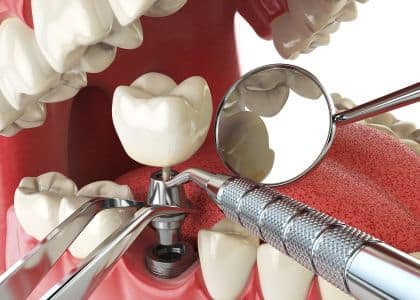 services dental implants