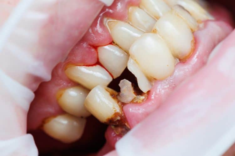 avoiding dental diseases with preventative dentistry