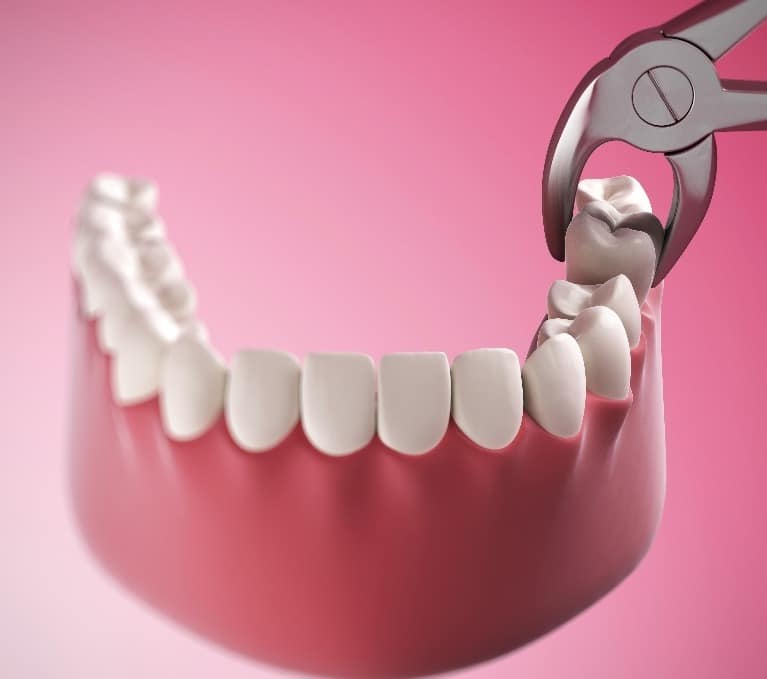 What Are the Costs of Dental Implants in Los Angeles?