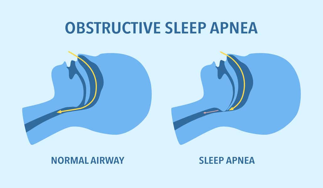 relief from sleep apnea benefit of bariatric surgery illustration