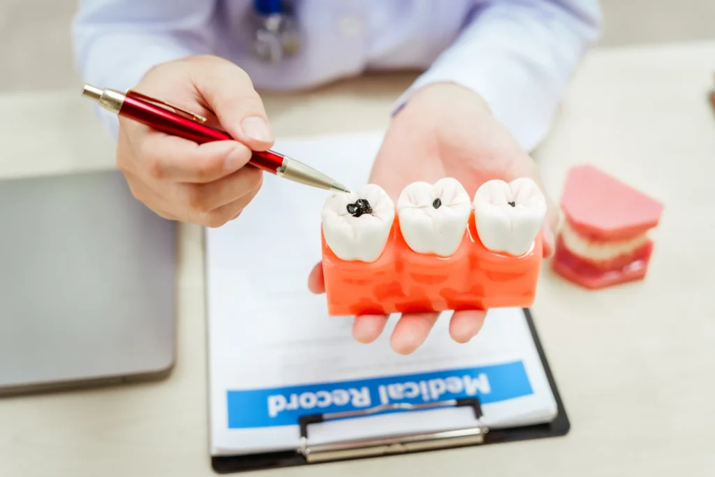 Dental Cavities in Los Angeles, CA