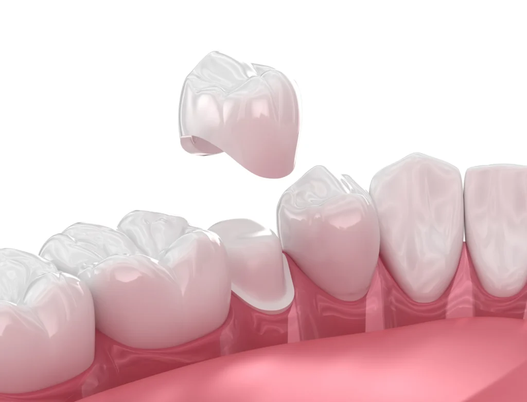 Custom Dental Crowns in Los Angeles