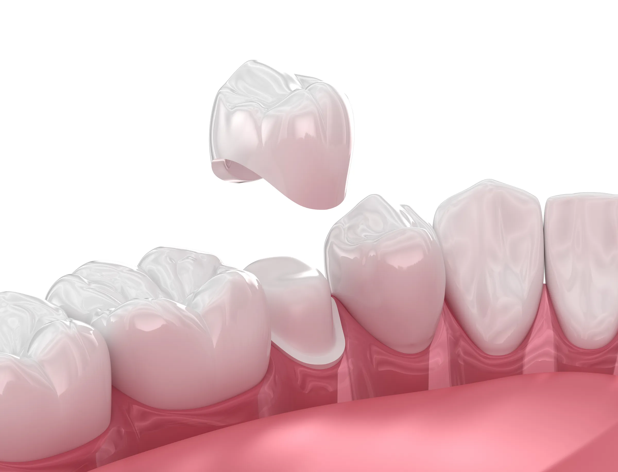 Custom Dental Crowns in Los Angeles